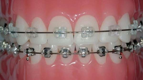 Dental Braces in Dubai | Affordable Ceramic Teeth Braces