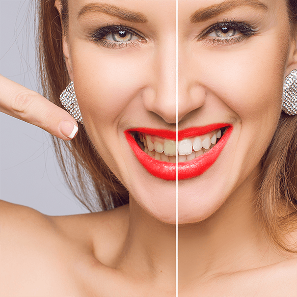 Benefits of Getting Snap One Smile Treatment