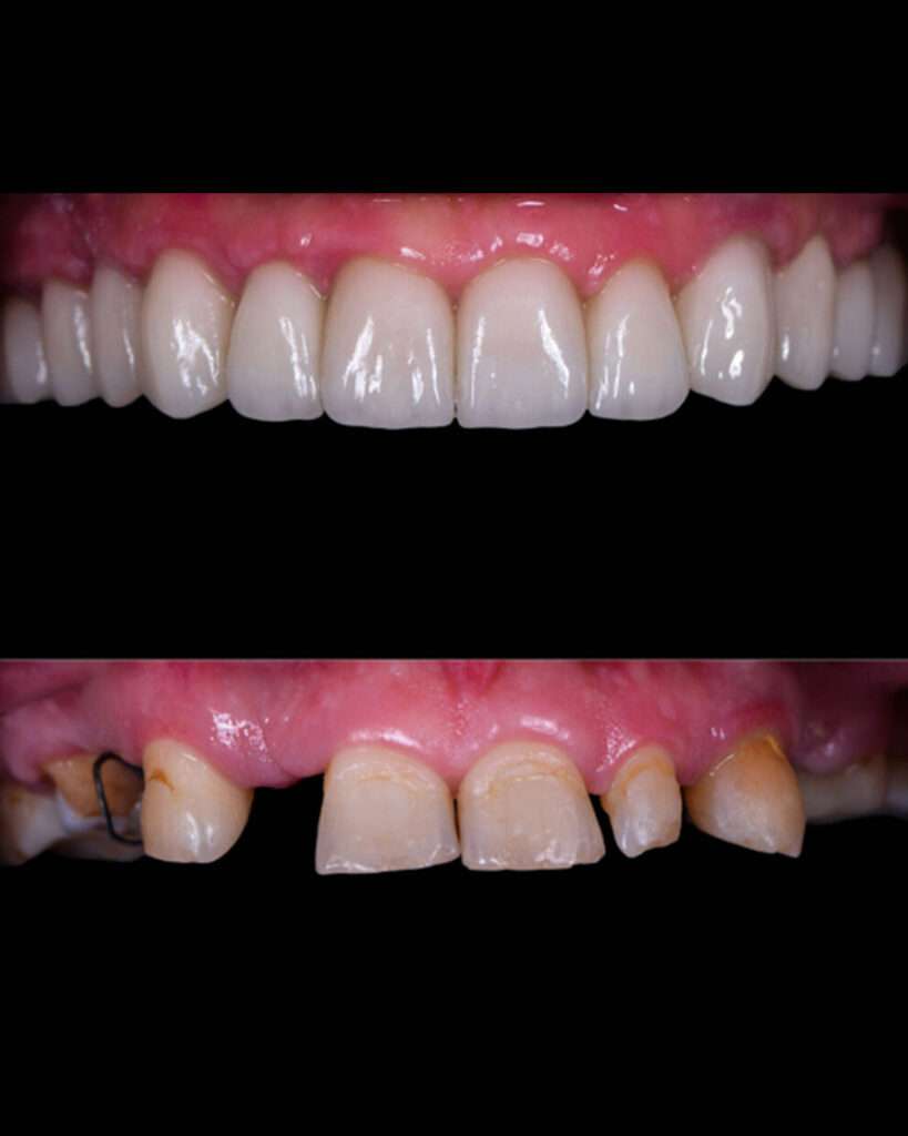 Benefits of Zirconia Teeth Crown