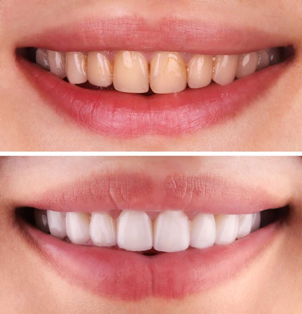 Benefits of using Zoom Teeth Whitening