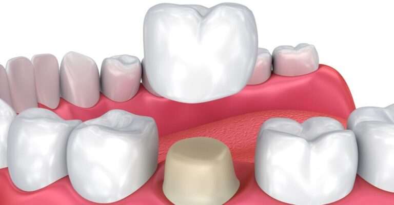 Dental Crowns