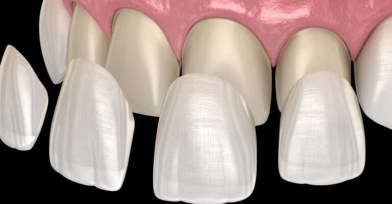 Dental Veneers