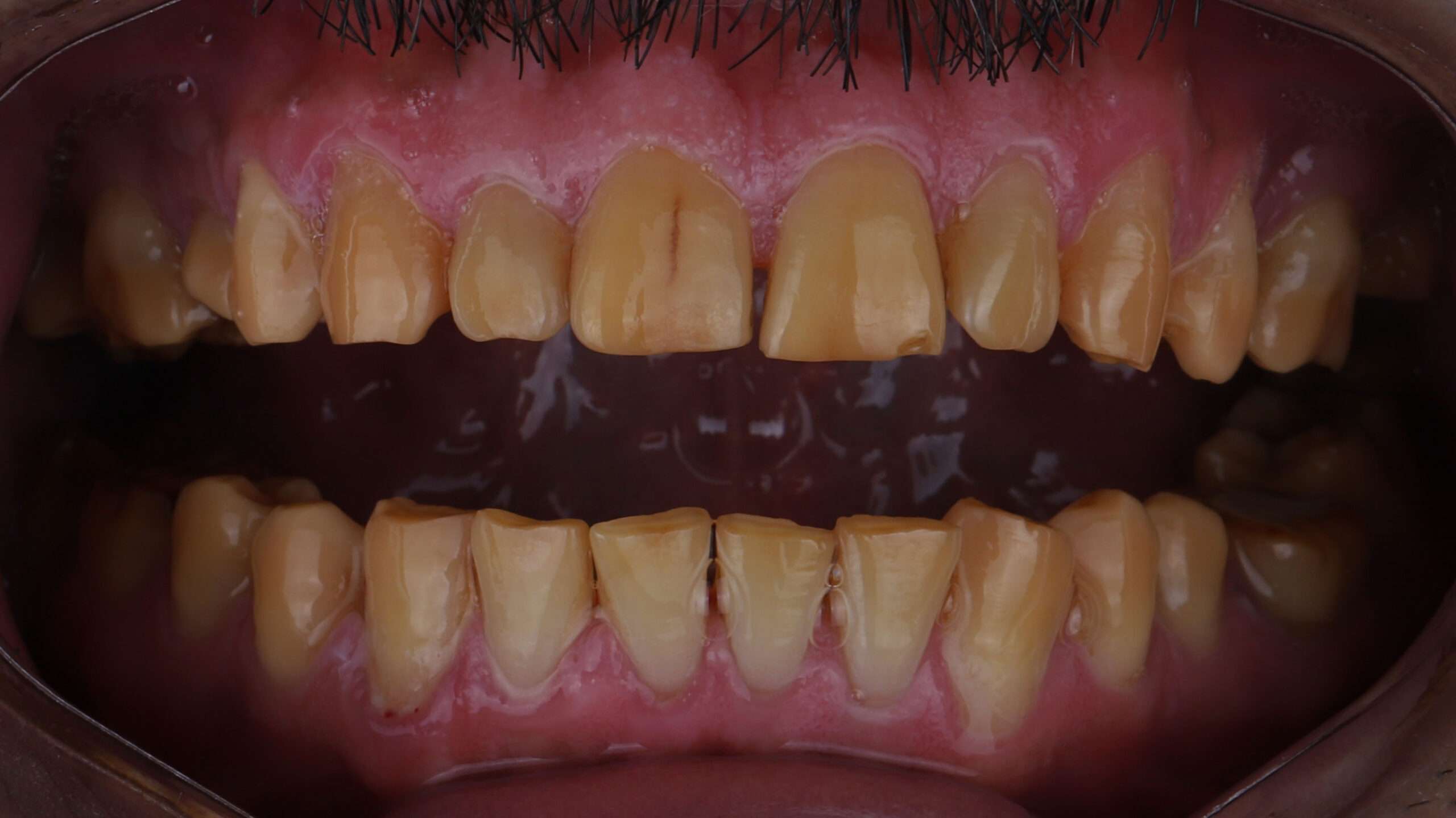 Dental Veneers slider 1(1)
