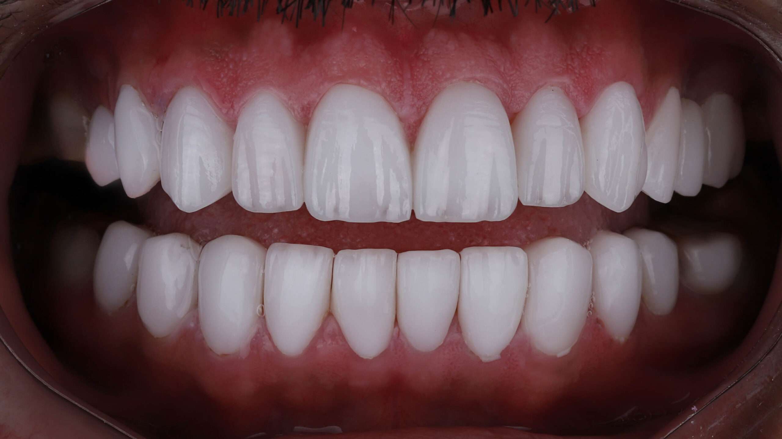 Dental Veneers slider 2(1)