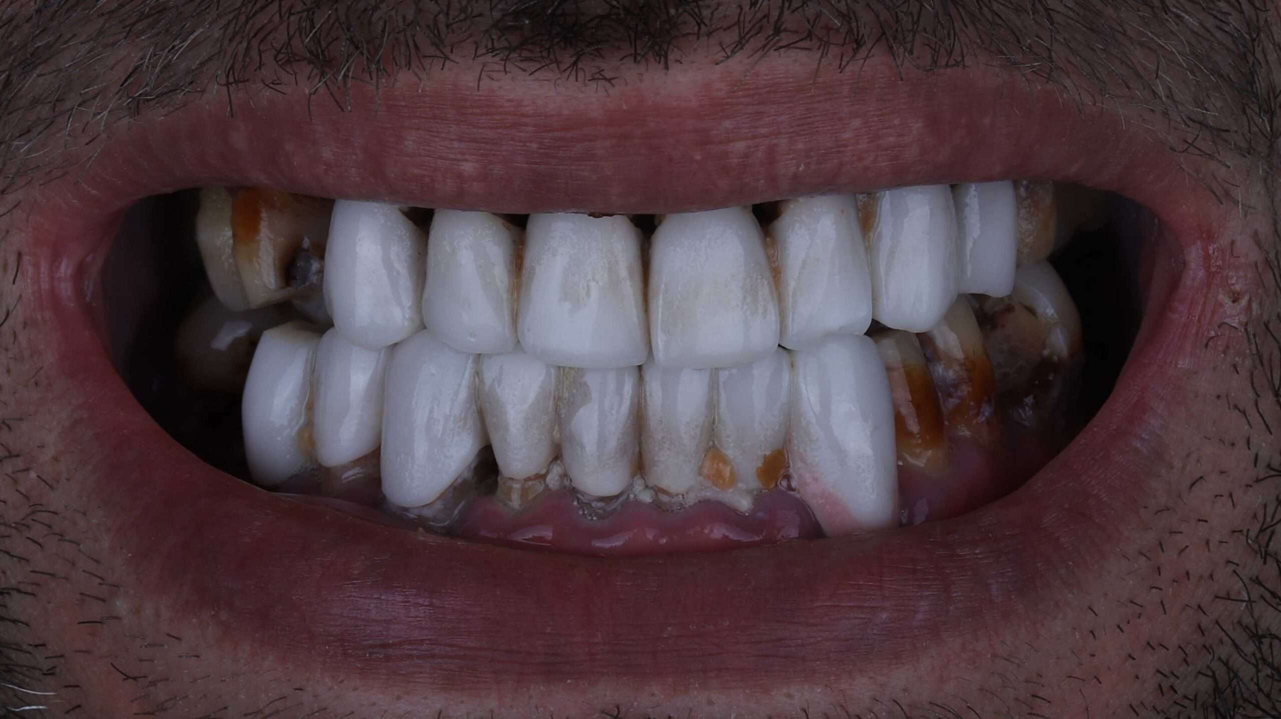Dental Veneers slider Nahour before