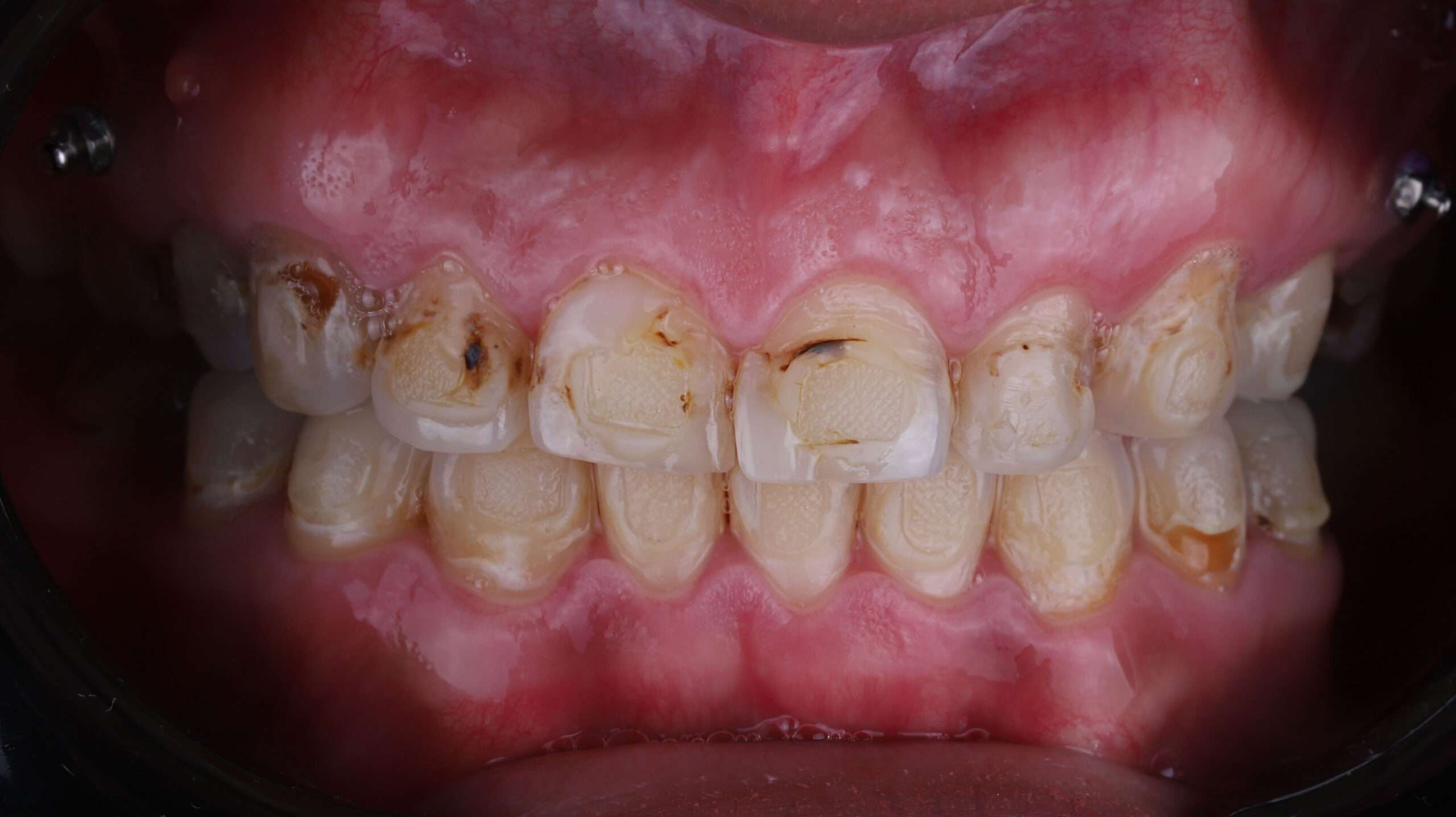 Dental Veneers slider trans after