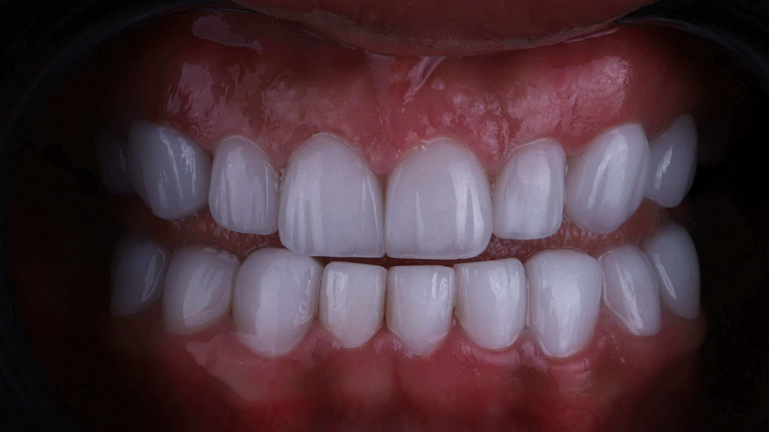 Dental Veneers slider trans before