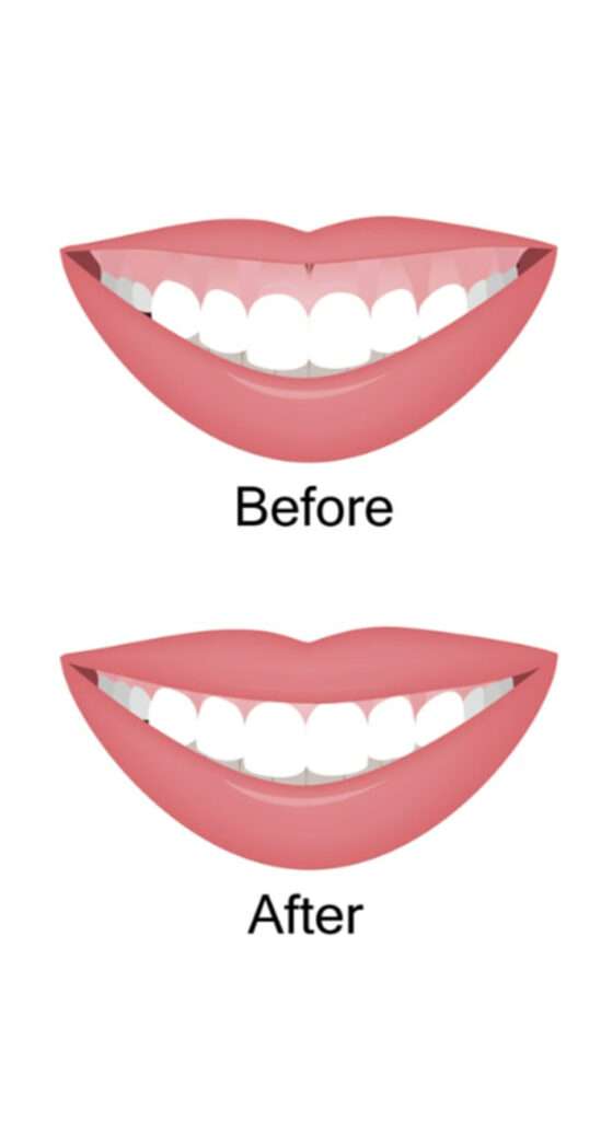 How Laser Gingivectomy Treatment is performed