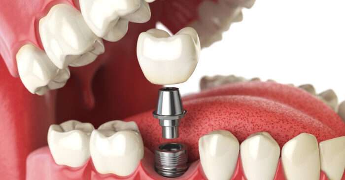 Dental Implant