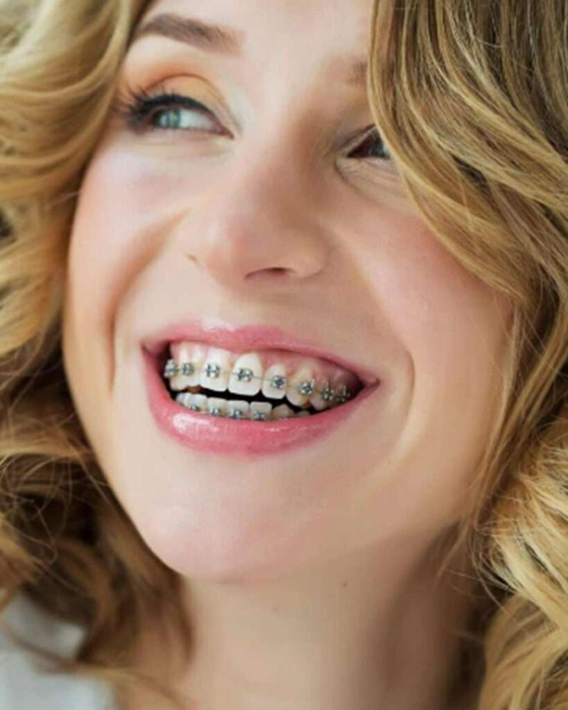 Is Dental Braces right for you