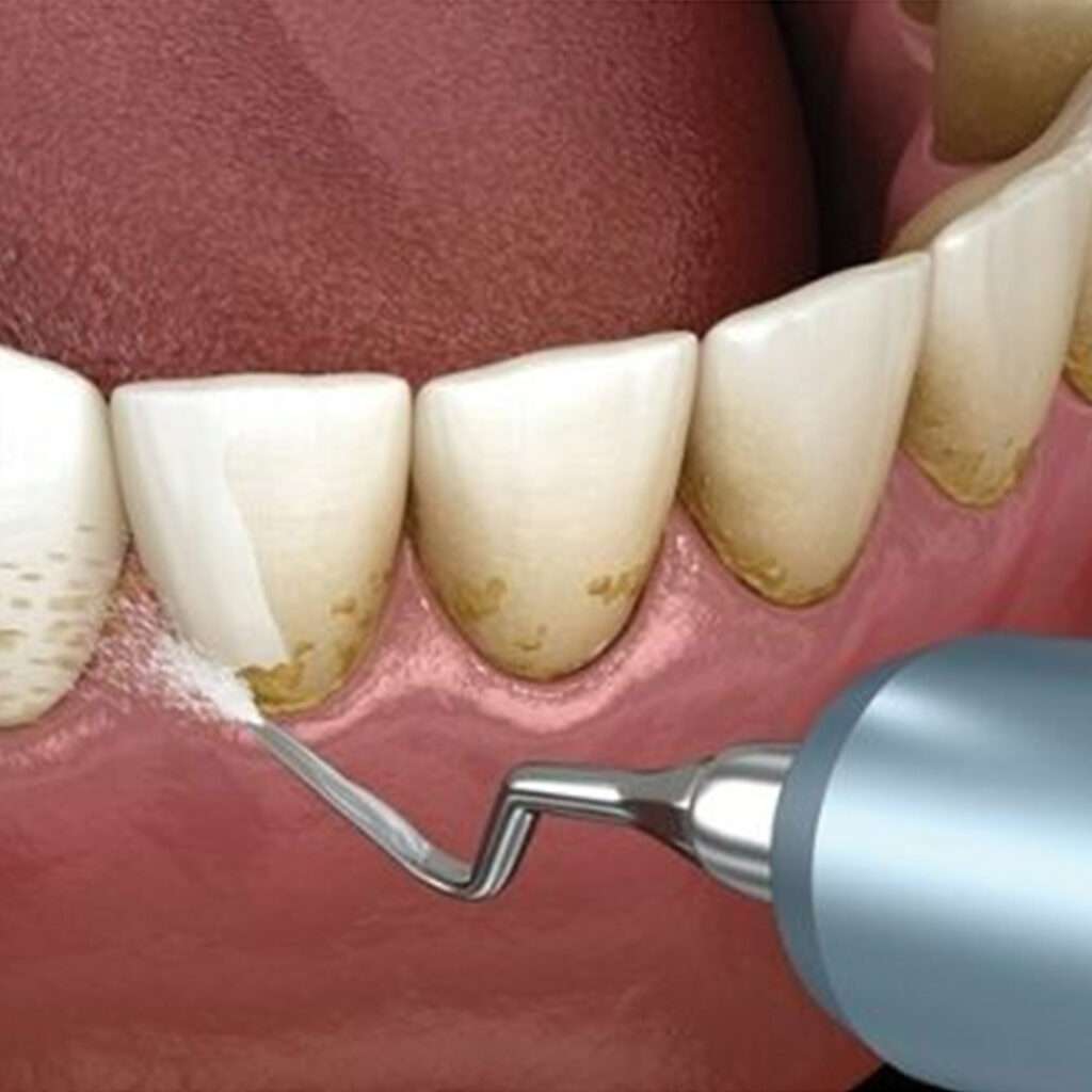 Surgical Treatment to Treat Gum Disease