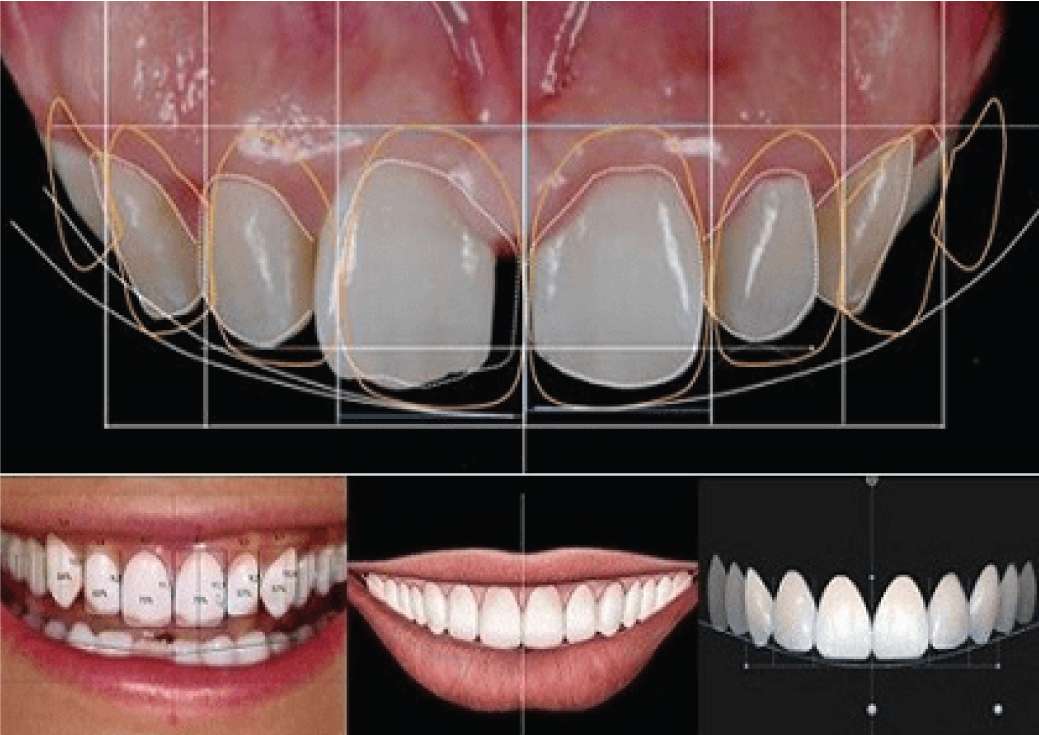 What is Digital Smile Design