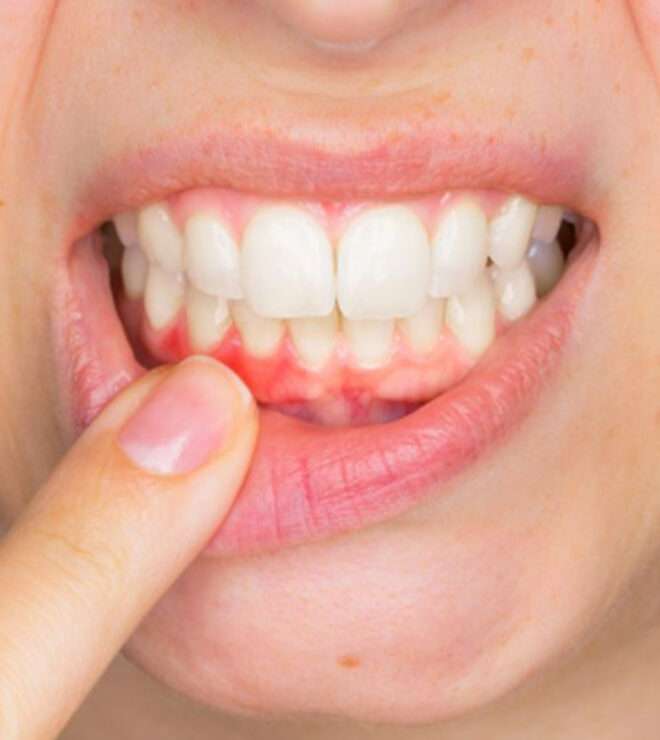 What is Gingivectomy treatment