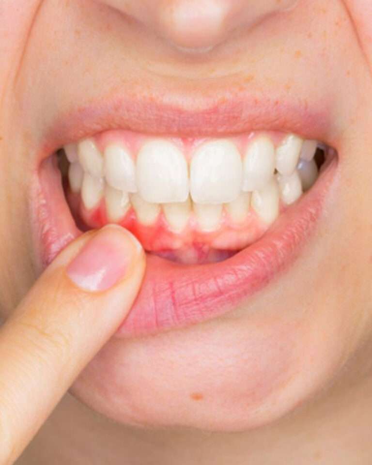 What is Gingivectomy treatment