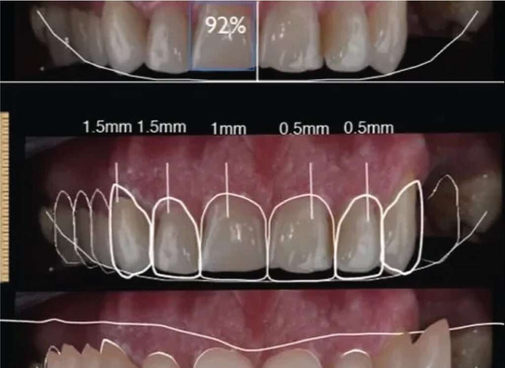 Main Purpose behind the Digital Smile Design