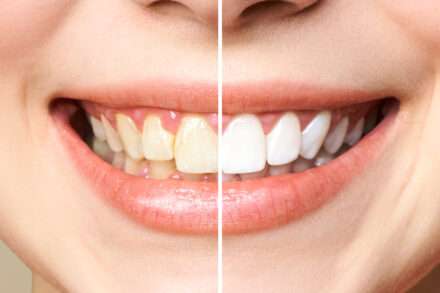 Zoom Teeth Whitening Treatment