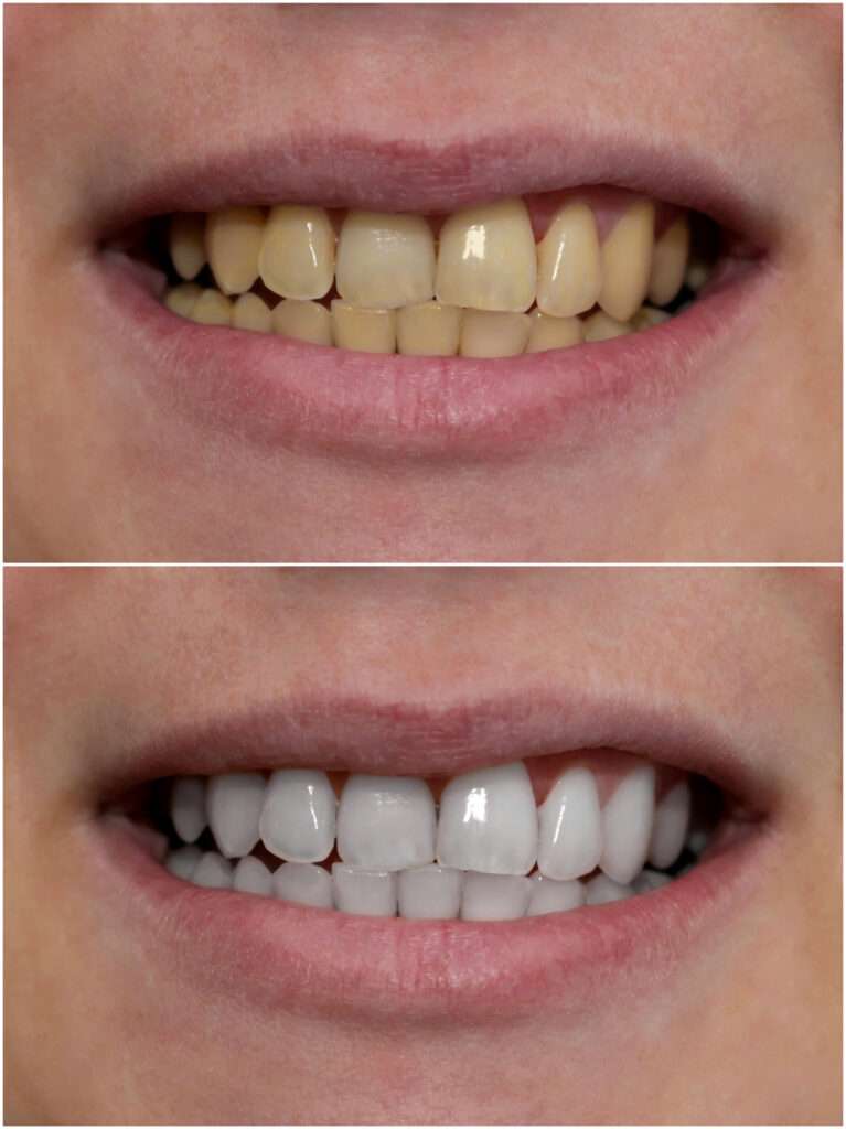 Zoom Teeth Whitening Treatment