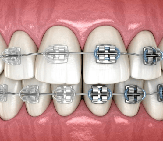 Get Affordable Dental Braces in Dubai