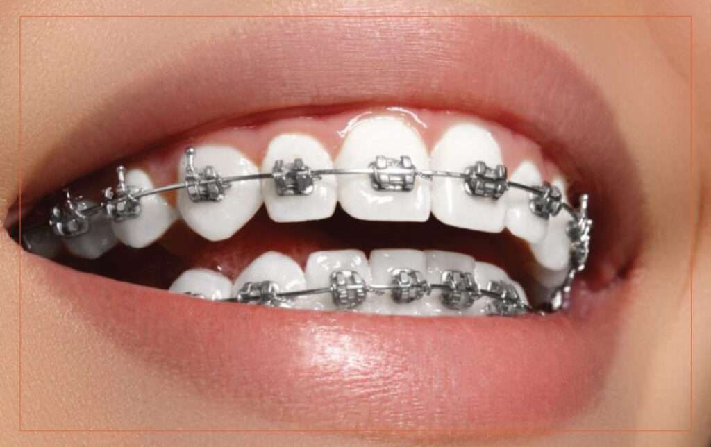 Metal Braces