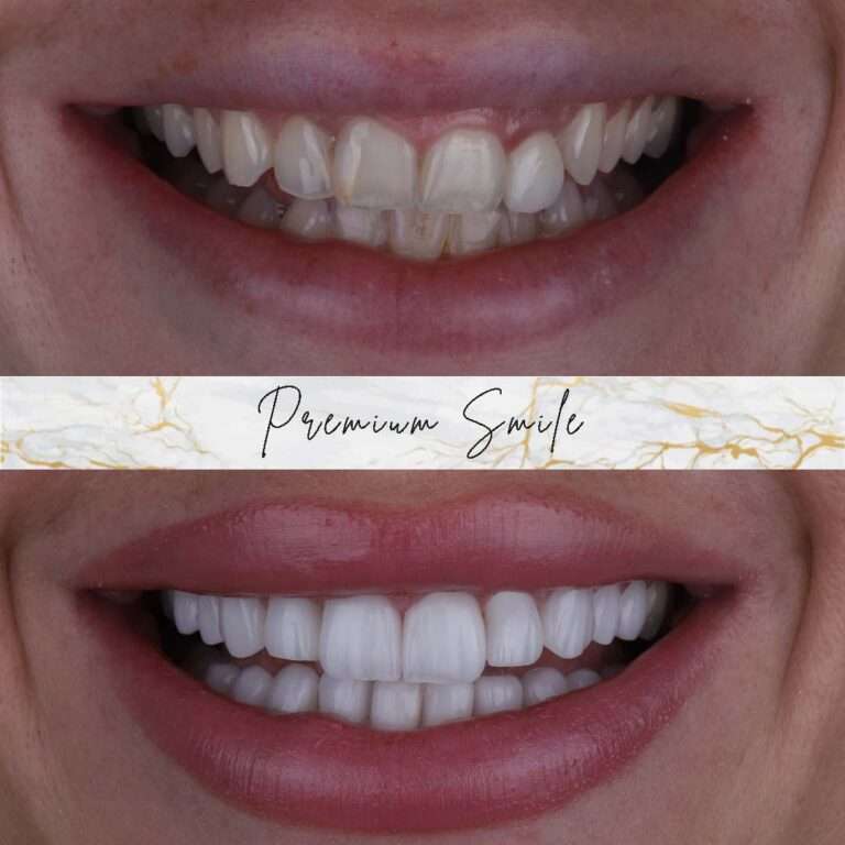 Hollywood smile cases