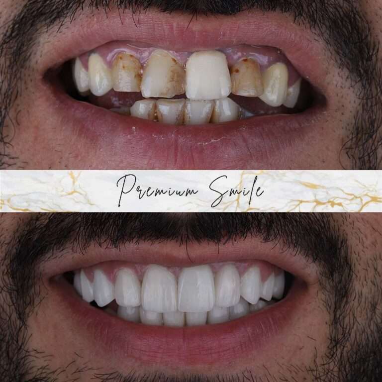 Hollywood smile cases