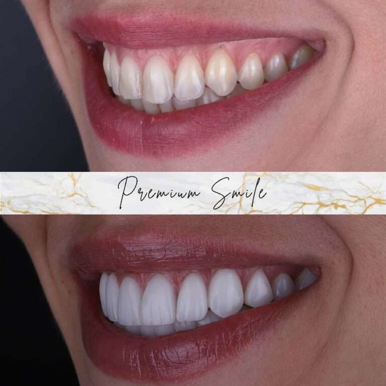 Hollywood smile cases