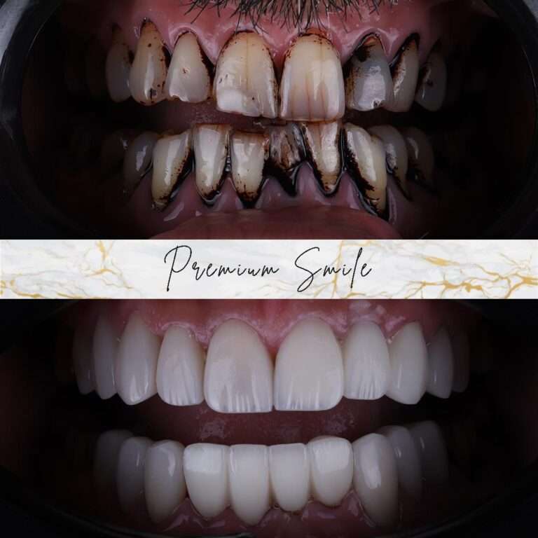 Hollywood smile cases