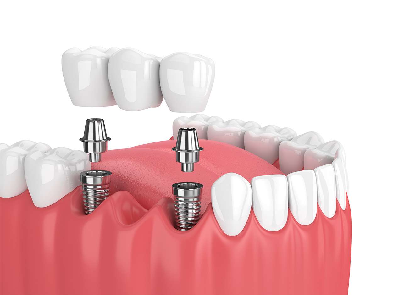 Dental Implants in Dubai