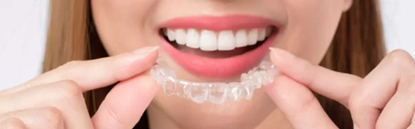 Dental Retainers